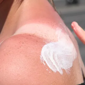 «Tanmaxxing»-Trend: Experten warnen vor Sonnenbrand